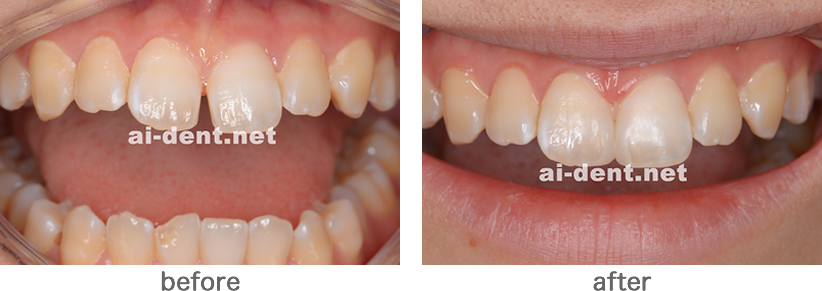 ダイレクトボンディングによるすきっ歯の治療