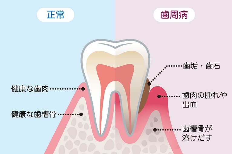 歯周病