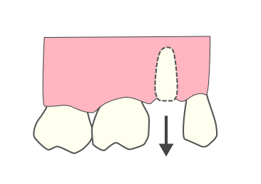 挺出（エクストルージョン，extrusion）