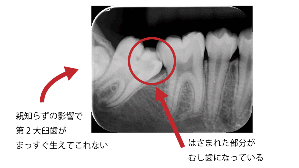 親知らずによる萌出障害