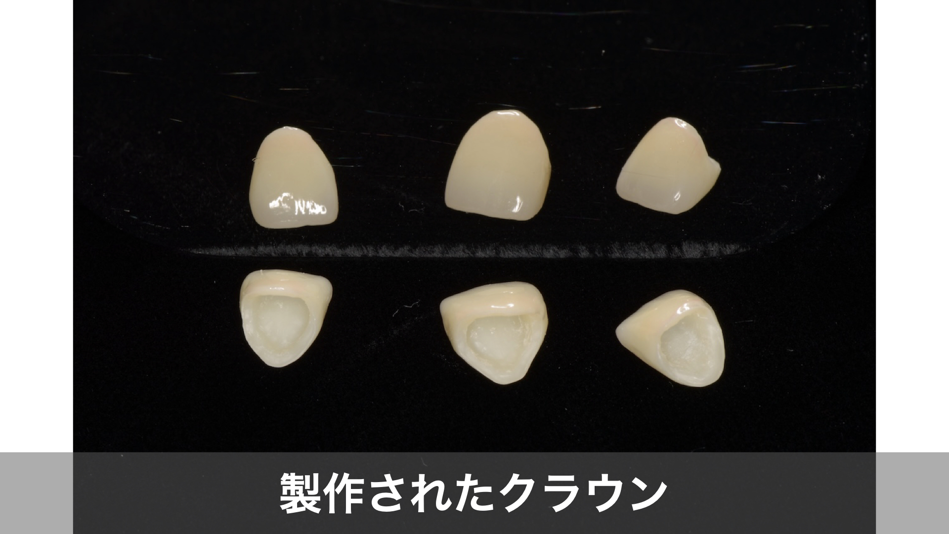 歯科技工所で製作されたセラミッククラウン