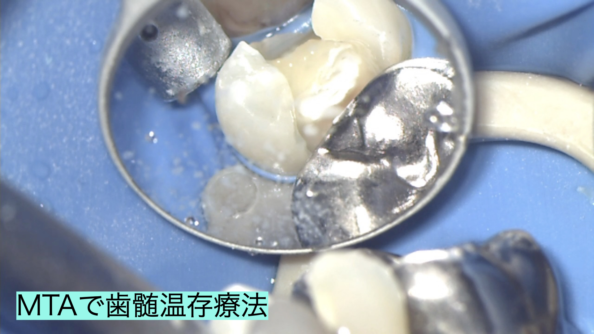 神経を残すむし歯治療｜歯髄温存療法＆ダイレクトボンディング症例（30代女性・#14-15）