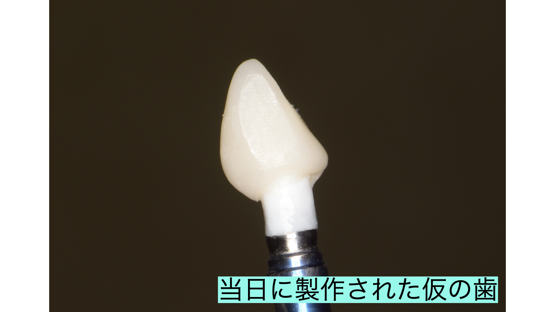 抜歯即時埋入・即時修復による前歯の再建（60代女性）
