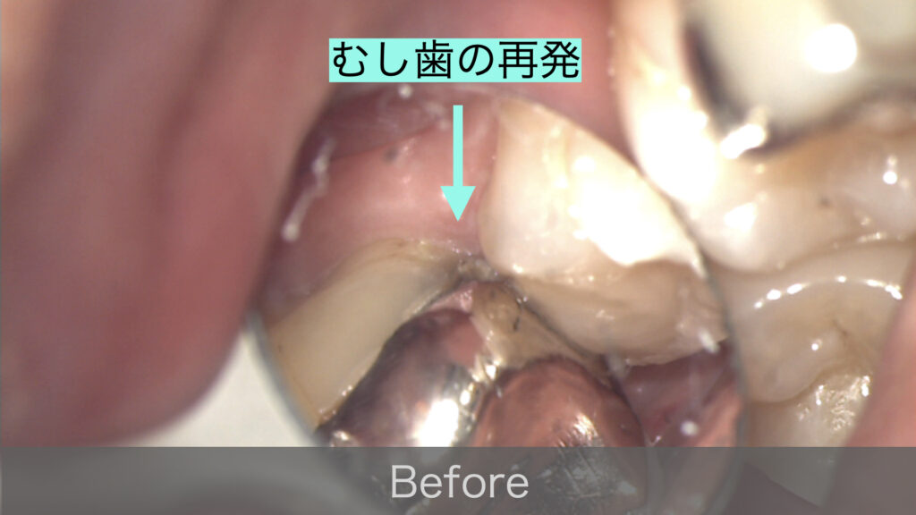 むし歯の再発(マイクロスコープ写真)