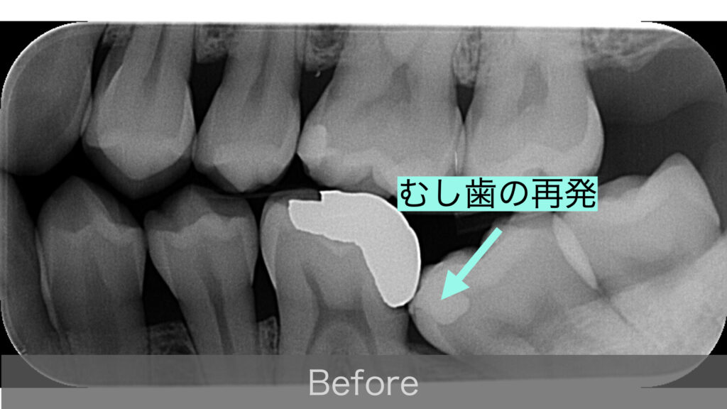 むし歯の再発(X線写真)