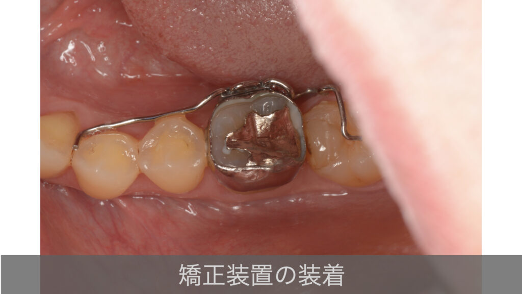 部分矯正装置の装着