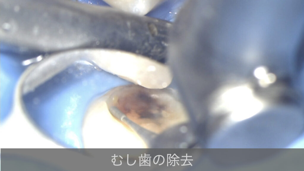 マイクロスコープで観察しながらむし歯の除去