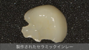 セラミックインレー