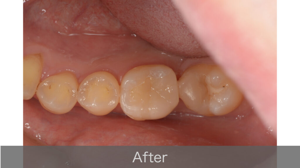 セラミックインレーを装着して治療完了