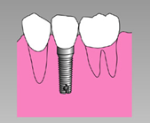 インプラント